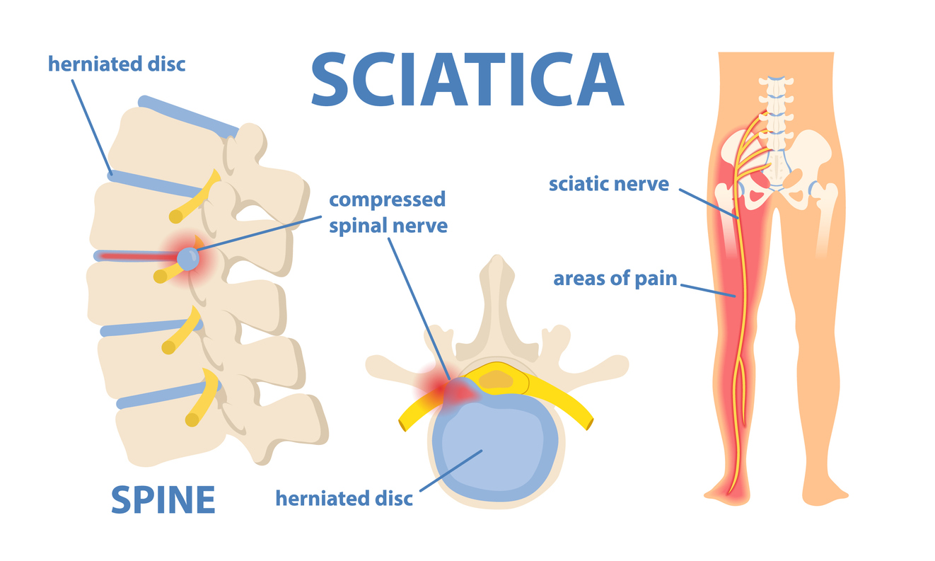 Sciatica Explained: How to Manage the Pain and Heal Naturally
